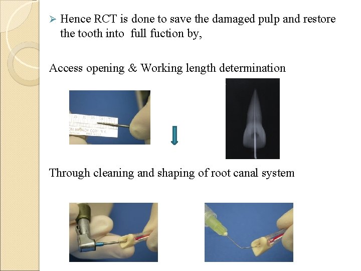 Ø Hence RCT is done to save the damaged pulp and restore the tooth