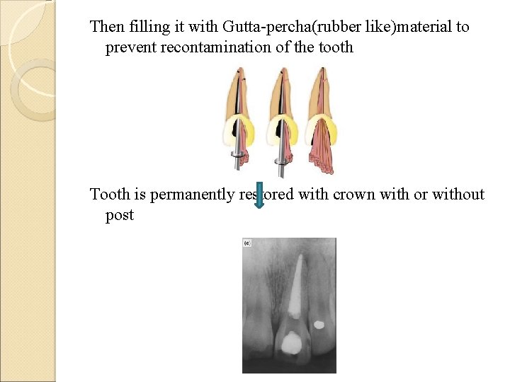 Then filling it with Gutta-percha(rubber like)material to prevent recontamination of the tooth Tooth is
