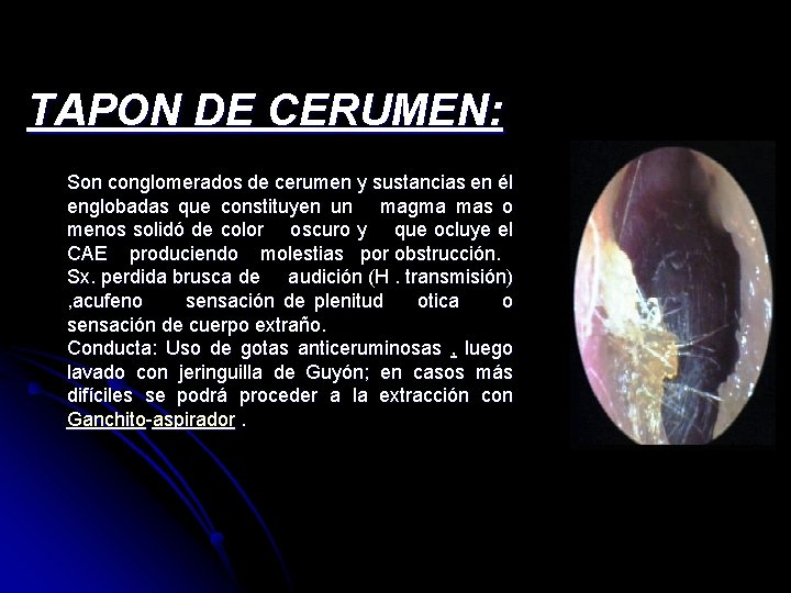 TAPON DE CERUMEN: Son conglomerados de cerumen y sustancias en él englobadas que constituyen TAPON DE CERUMEN: Son conglomerados de cerumen y sustancias en él englobadas que constituyen