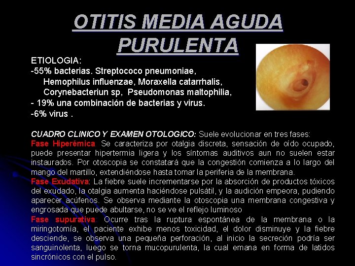 OTITIS MEDIA AGUDA PURULENTA ETIOLOGIA: -55% bacterias. Streptococo pneumoniae, Hemophilus influenzae, Moraxella catarrhalis, Corynebacteriun OTITIS MEDIA AGUDA PURULENTA ETIOLOGIA: -55% bacterias. Streptococo pneumoniae, Hemophilus influenzae, Moraxella catarrhalis, Corynebacteriun