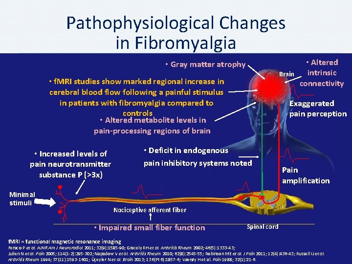 Pathophysiological Changes in Fibromyalgia • Gray matter atrophy Brain • f. MRI studies show