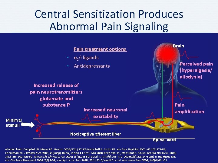 Central Sensitization Produces Abnormal Pain Signaling Pain treatment options Brain • α 2δ ligands