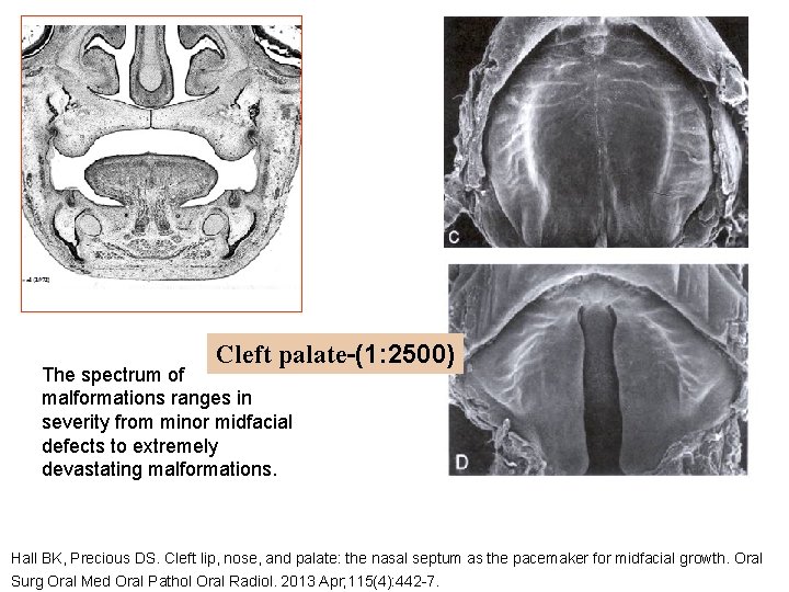 Cleft palate-(1: 2500) The spectrum of malformations ranges in severity from minor midfacial defects