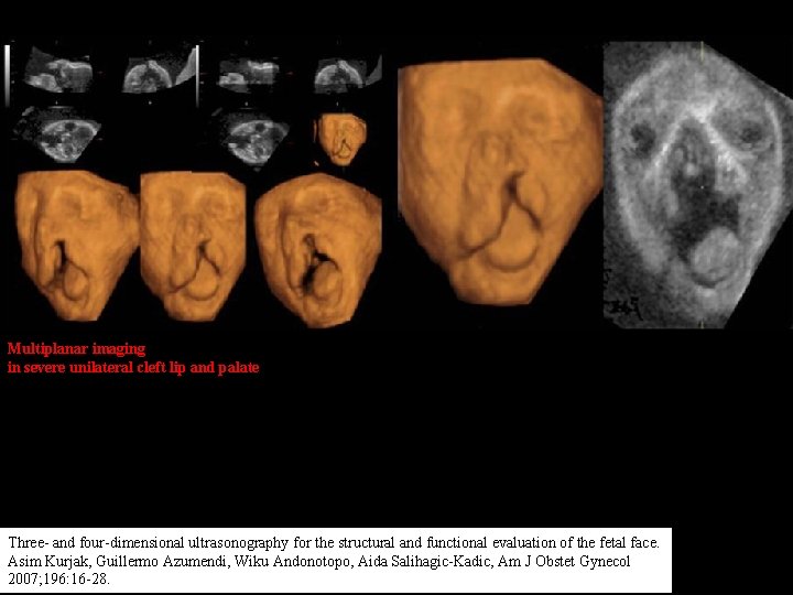 Multiplanar imaging in severe unilateral cleft lip and palate Three- and four-dimensional ultrasonography for