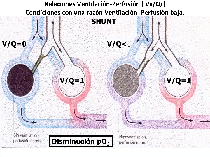 Relaciones Ventilación-Perfusión ( VA/Qc) Condiciones con una razón Ventilación- Perfusión baja. Disminución p. O