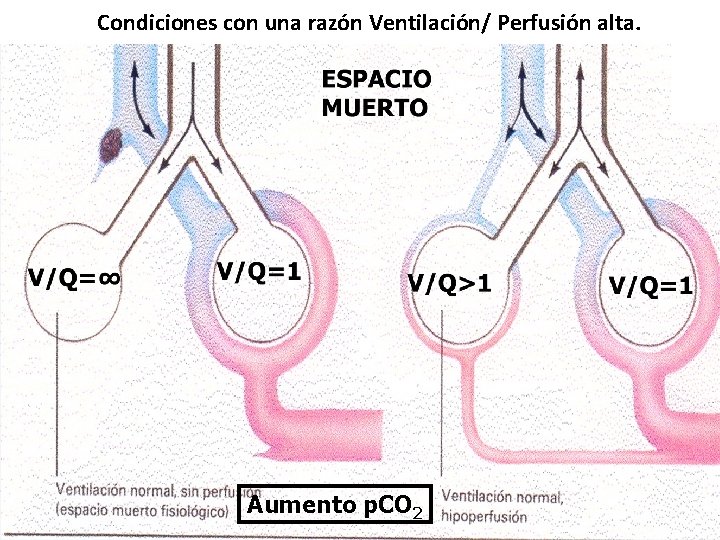 Condiciones con una razón Ventilación/ Perfusión alta. Aumento p. CO 2 
