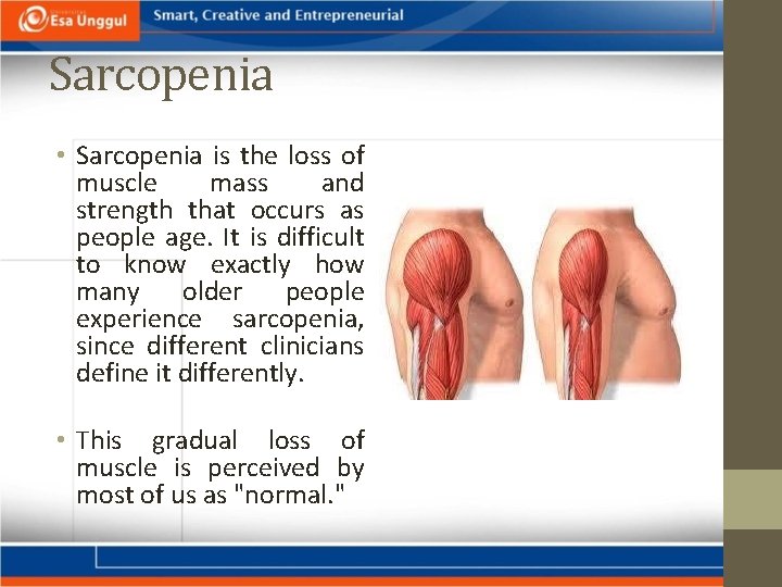 Sarcopenia • Sarcopenia is the loss of muscle mass and strength that occurs as