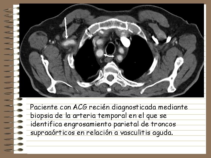 Paciente con ACG recién diagnosticada mediante biopsia de la arteria temporal en el que