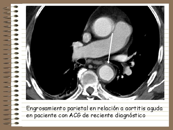 Engrosamiento parietal en relación a aortitis aguda en paciente con ACG de reciente diagnóstico