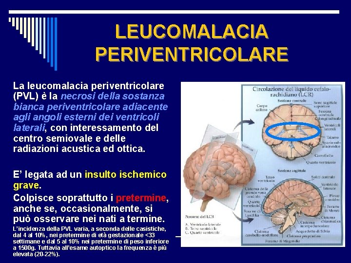 LEUCOMALACIA PERIVENTRICOLARE La leucomalacia periventricolare (PVL) è la necrosi della sostanza bianca periventricolare adiacente