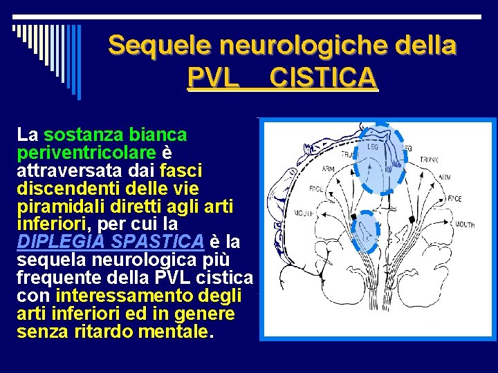 Sequele neurologiche della PVL CISTICA La sostanza bianca periventricolare è attraversata dai fasci discendenti