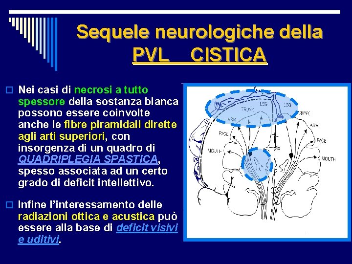 Sequele neurologiche della PVL CISTICA o Nei casi di necrosi a tutto spessore della
