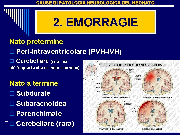 CAUSE DI PATOLOGIA NEUROLOGICA DEL NEONATO 2. EMORRAGIE Nato pretermine o Peri-Intraventricolare (PVH-IVH) o