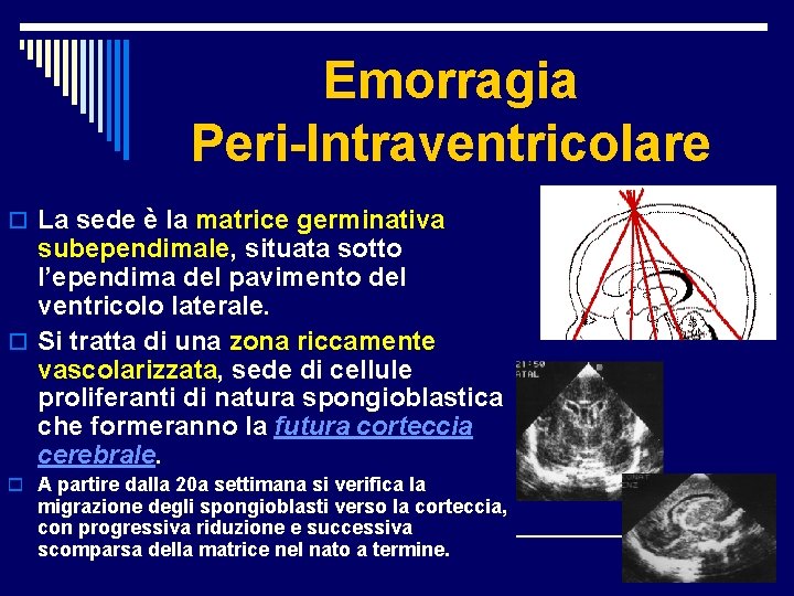 Emorragia Peri-Intraventricolare o La sede è la matrice germinativa subependimale, situata sotto l’ependima del