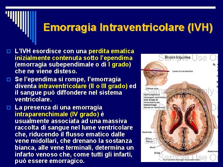Emorragia Intraventricolare (IVH) o L’IVH esordisce con una perdita ematica inizialmente contenuta sotto l’ependima
