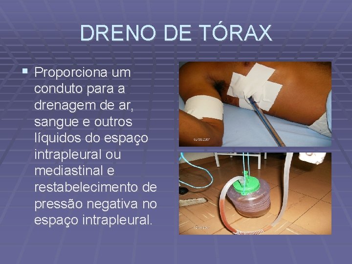 DRENO DE TÓRAX Proporciona um conduto para a drenagem de ar, sangue e outros