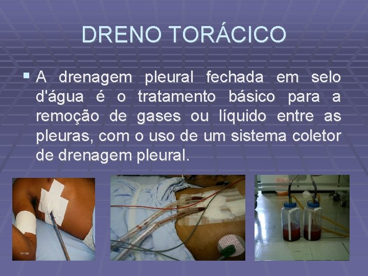DRENO TORÁCICO A drenagem pleural fechada em selo d'água é o tratamento básico para
