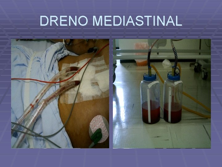 DRENO MEDIASTINAL 