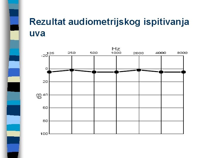 Rezultat audiometrijskog ispitivanja uva 