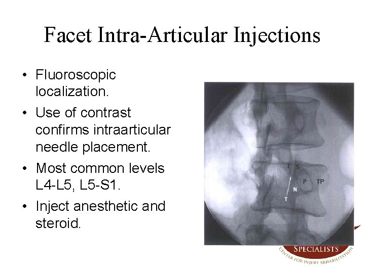 Facet Intra-Articular Injections • Fluoroscopic localization. • Use of contrast confirms intraarticular needle placement.