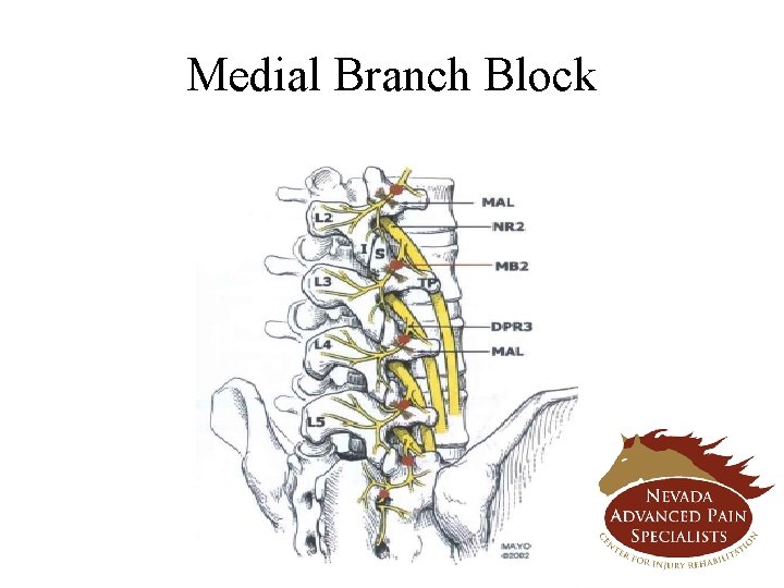 Medial Branch Block 