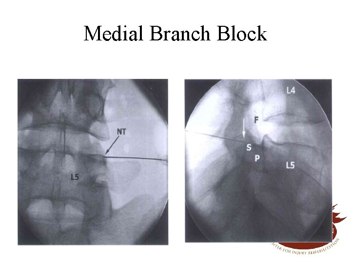 Medial Branch Block 