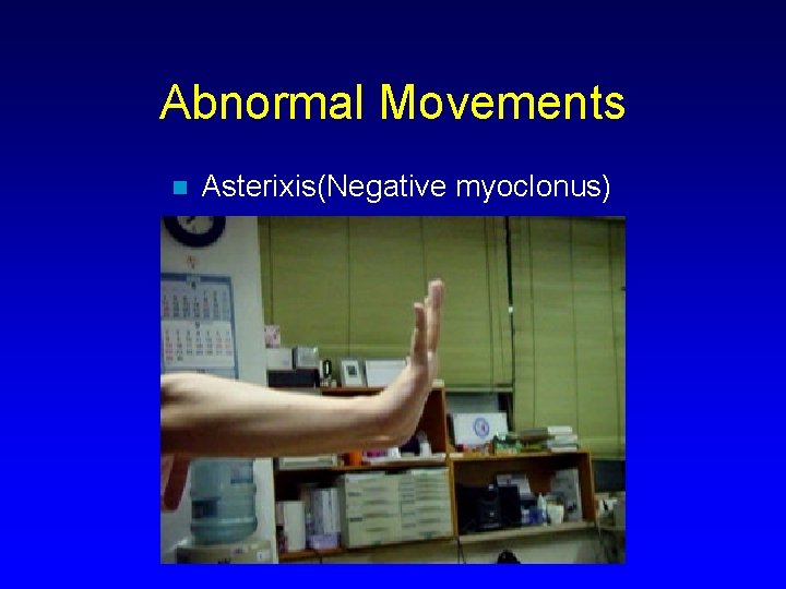 Abnormal Movements n Asterixis(Negative myoclonus) 