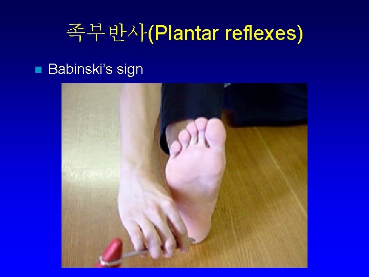 족부반사(Plantar reflexes) n Babinski’s sign 