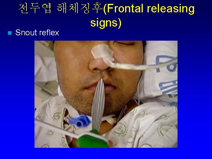 전두엽 해체징후(Frontal releasing signs) n Snout reflex 