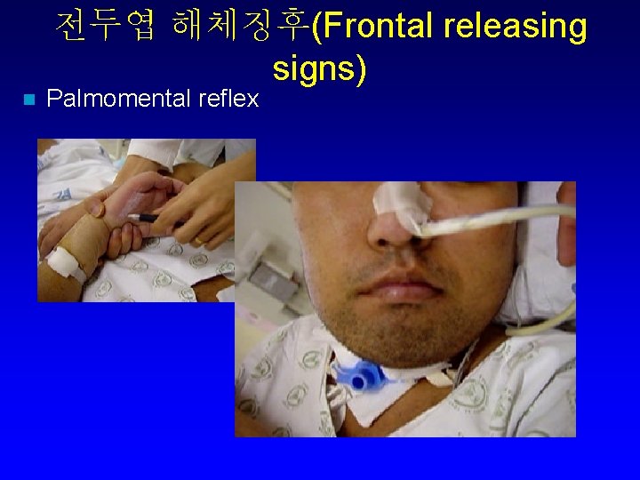 전두엽 해체징후(Frontal releasing signs) n Palmomental reflex 