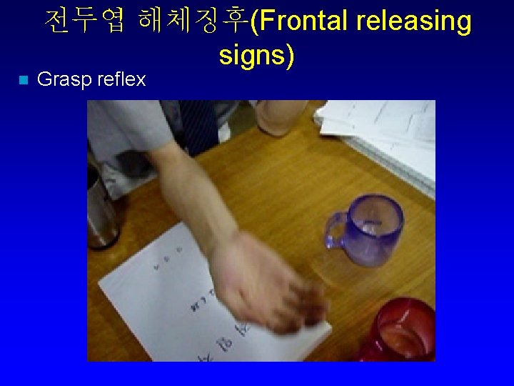 전두엽 해체징후(Frontal releasing signs) n Grasp reflex 