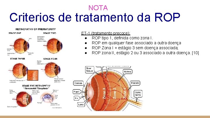 NOTA Criterios de tratamento da ROP ET-1 (tratamento precoce): ● ROP tipo 1, definida