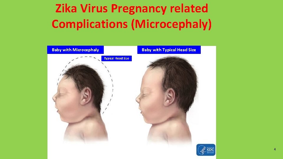Zika Virus Pregnancy related Complications (Microcephaly) Baby with Typical Head Size Baby with Microcephaly Zika Virus Pregnancy related Complications (Microcephaly) Baby with Typical Head Size Baby with Microcephaly