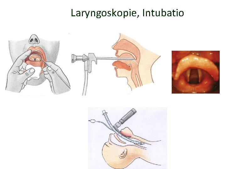 Laryngoskopie, Intubatio 