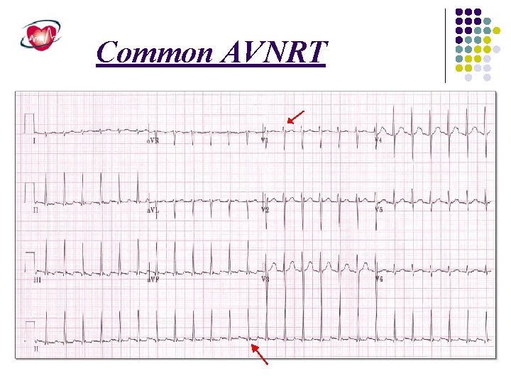 Common AVNRT 