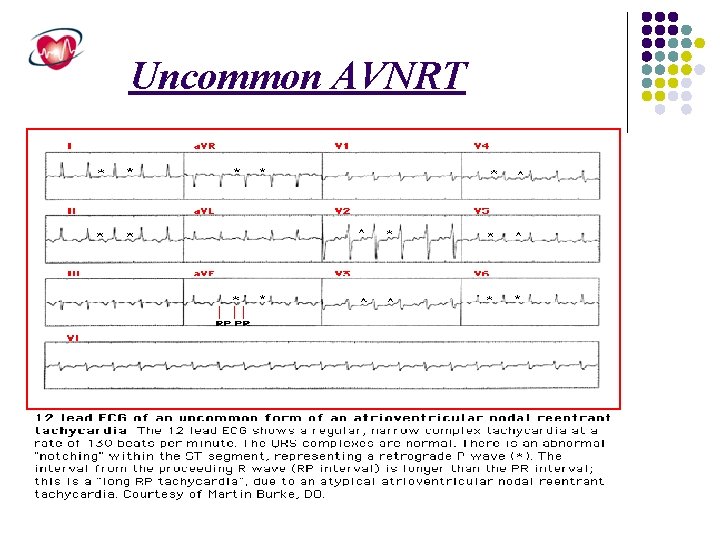 Uncommon AVNRT 