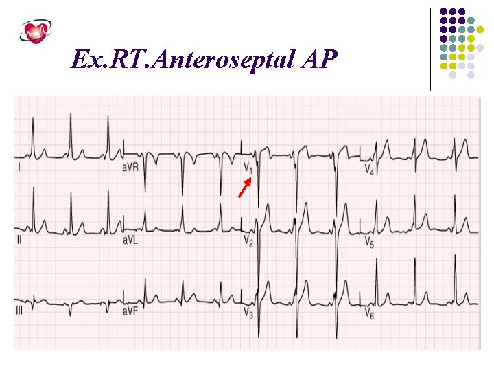 Ex. RT. Anteroseptal AP 