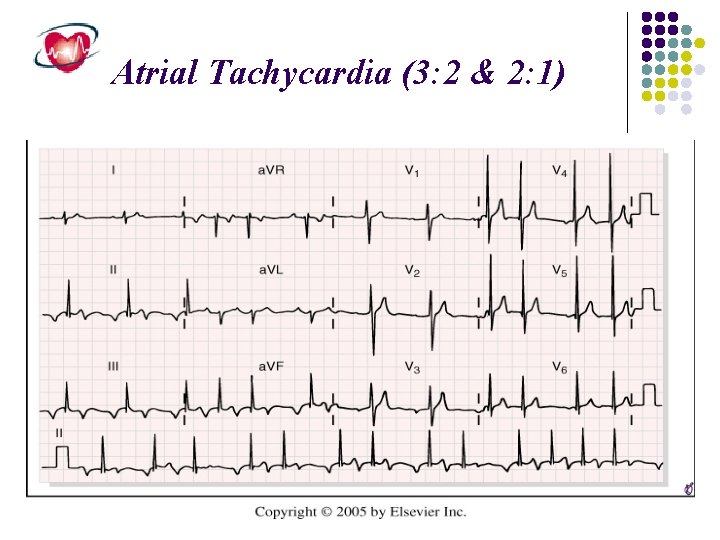 Atrial Tachycardia (3: 2 & 2: 1) 