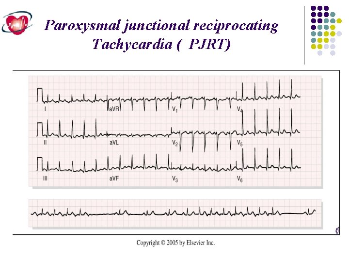 Paroxysmal junctional reciprocating Tachycardia ( PJRT) 