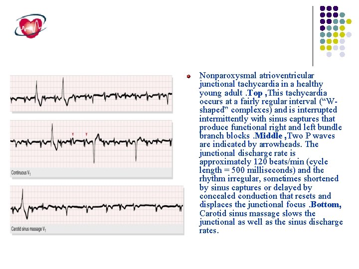 Nonparoxysmal atrioventricular junctional tachycardia in a healthy young adult. Top , This tachycardia occurs