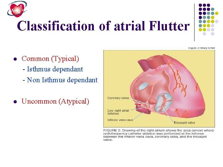 Classification of atrial Flutter l Common (Typical) - Isthmus dependant - Non Isthmus dependant