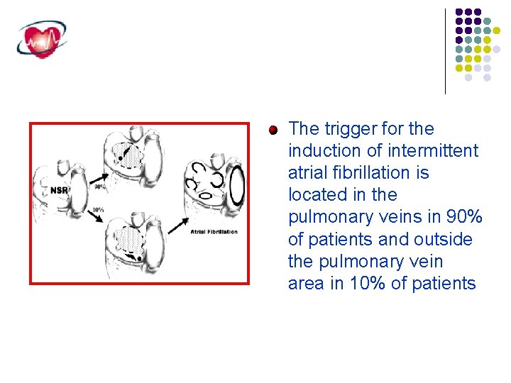 The trigger for the induction of intermittent atrial fibrillation is located in the pulmonary