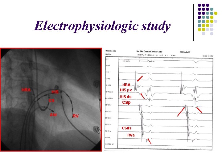 Electrophysiologic study HRA HIS px HIS ds CS Abl CSp RV CSds RVa 