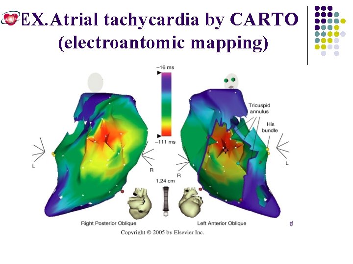 EX. Atrial tachycardia by CARTO (electroantomic mapping) 