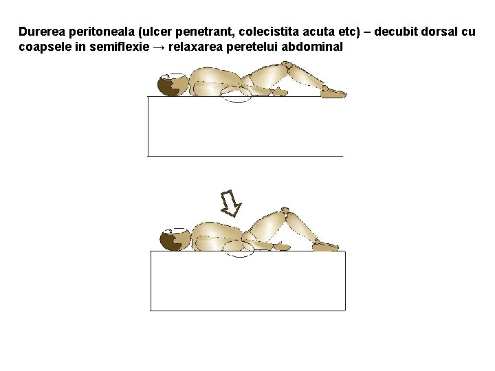 Durerea peritoneala (ulcer penetrant, colecistita acuta etc) – decubit dorsal cu coapsele in semiflexie