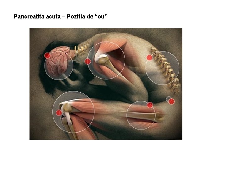 Pancreatita acuta – Pozitia de “ou” 