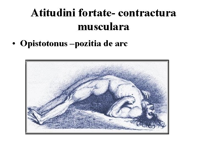 Atitudini fortate- contractura musculara • Opistotonus –pozitia de arc 