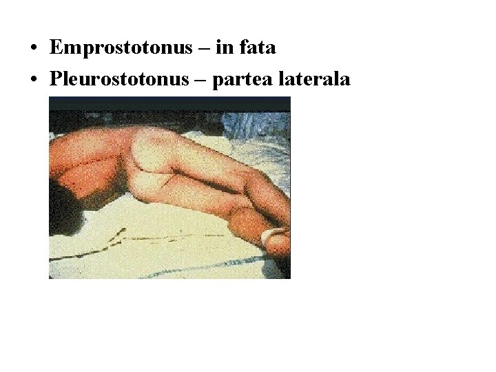  • Emprostotonus – in fata • Pleurostotonus – partea laterala 