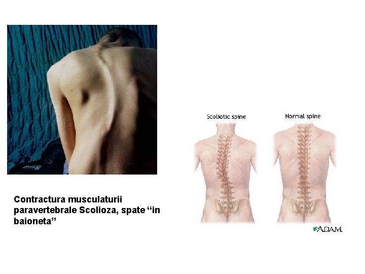 Contractura musculaturii paravertebrale Scolioza, spate “in baioneta” 