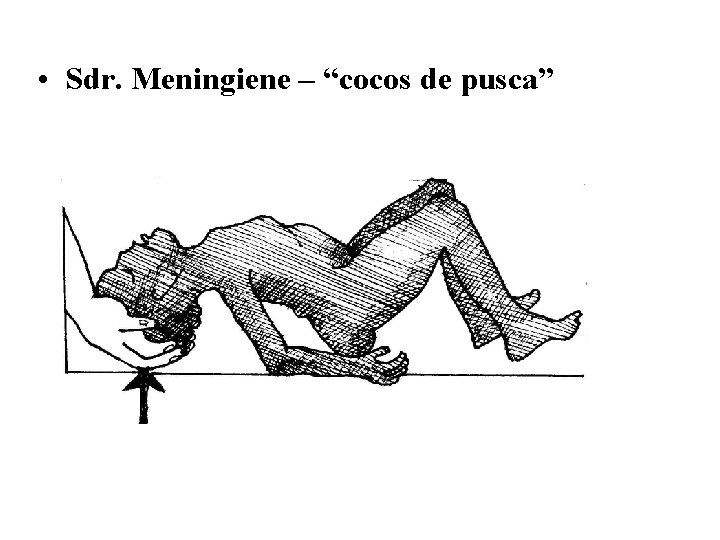  • Sdr. Meningiene – “cocos de pusca” 